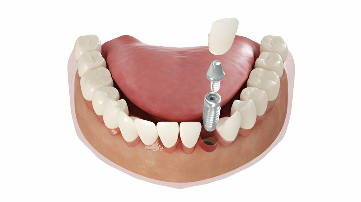 single tooth dental implants edmonton